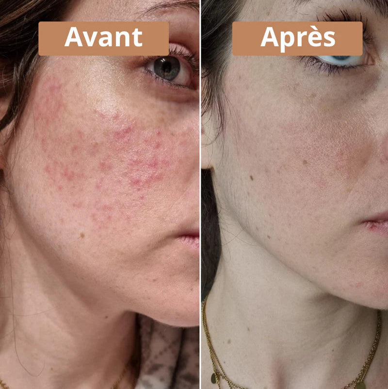 Baume Pissenlit – Peaux à Problèmes & Inflammations