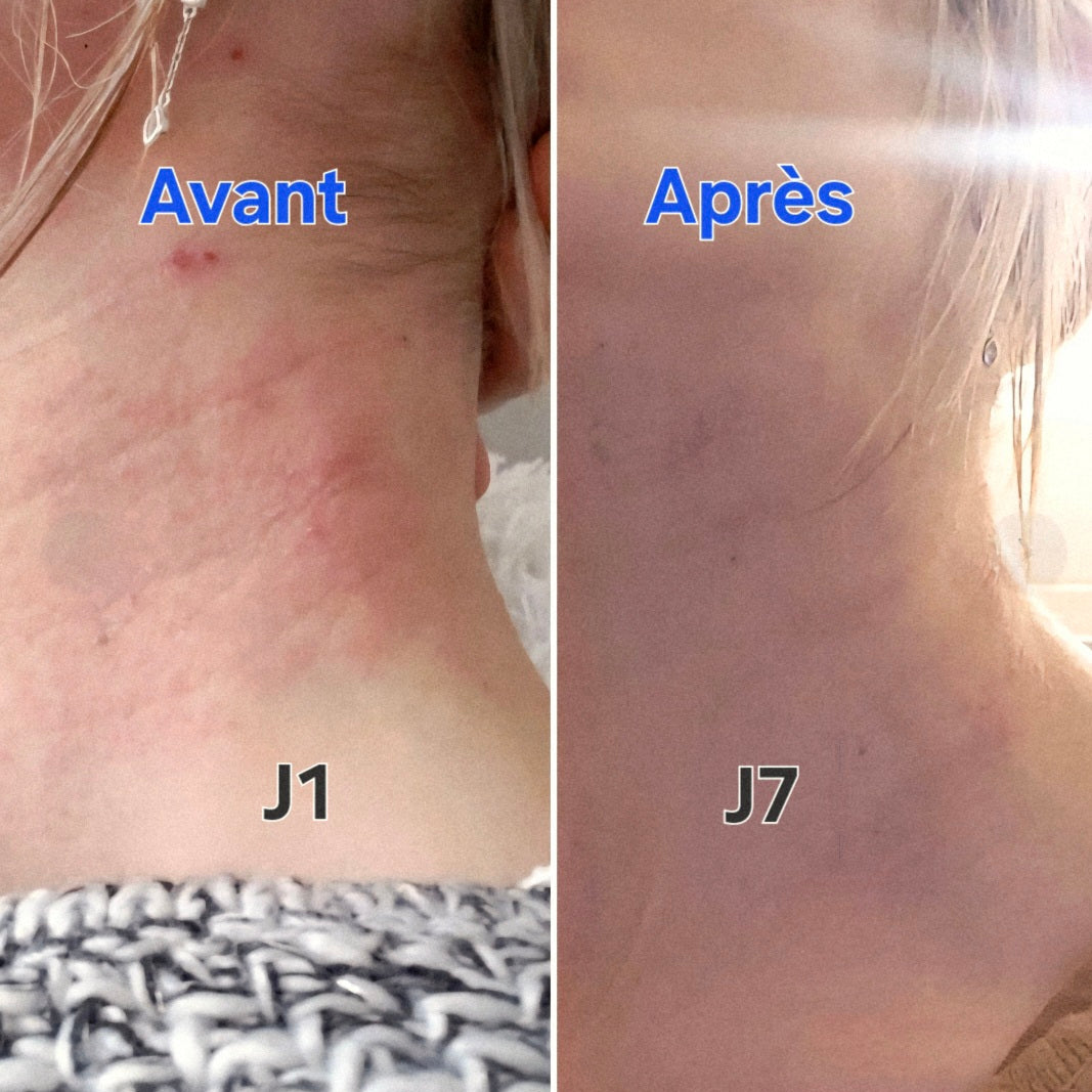 Baume Pissenlit – Peaux à Problèmes & Inflammations