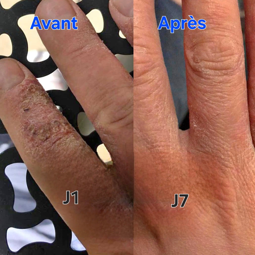 Baume Pissenlit – Peaux à Problèmes & Inflammations